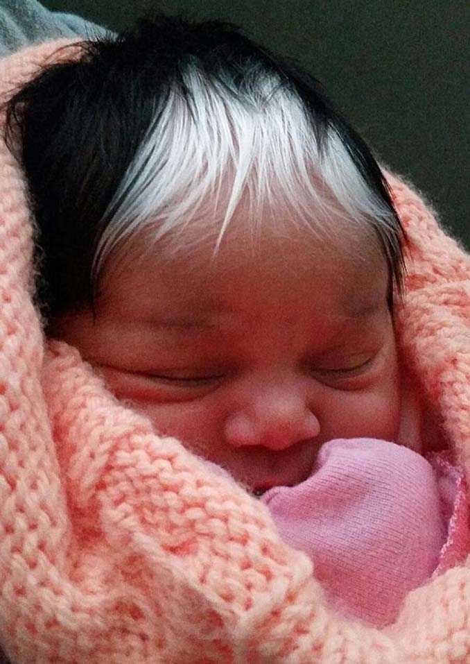 Κοριτσάκι γεννήθηκε με μια άσπρη τούφα μαλλιών στο ίδιο σημείο που την έχει και η μητέρα της (1)