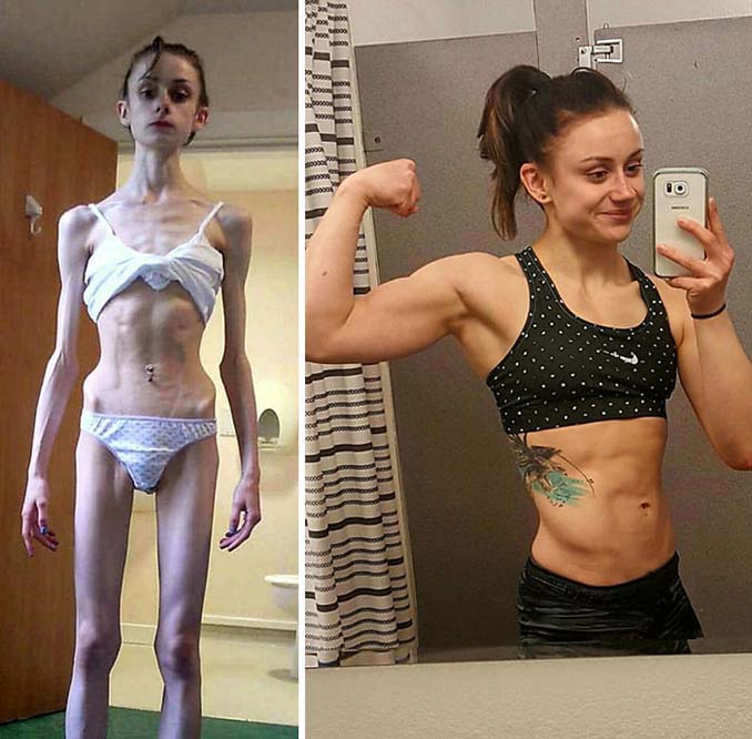 Πριν και Μετά - Εκπληκτικές φωτογραφίες ανθρώπων που νίκησαν την ανορεξία (1)