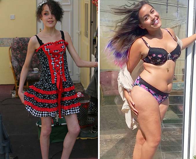 Πριν και Μετά - Εκπληκτικές φωτογραφίες ανθρώπων που νίκησαν την ανορεξία (5)
