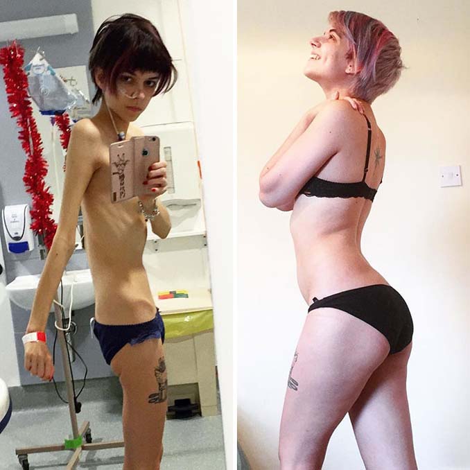 Πριν και Μετά - Εκπληκτικές φωτογραφίες ανθρώπων που νίκησαν την ανορεξία (7)