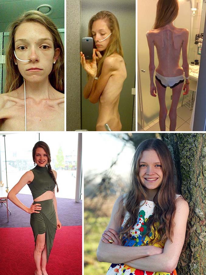 Πριν και Μετά - Εκπληκτικές φωτογραφίες ανθρώπων που νίκησαν την ανορεξία (11)